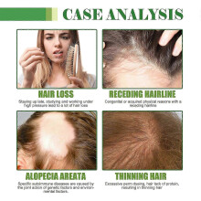 Revitalize Hair Growth & Nourish Dry Hair with Ginger, Rosemary & Ginseng Oil