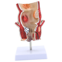 Human Rectum Model Human Anatomical Model Human Pathologies of Rectum Model
