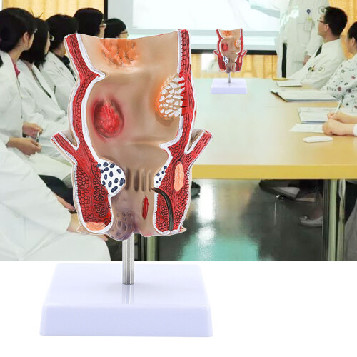 Human Rectum Model Human Anatomical Model Human Pathologies of Rectum Model 2