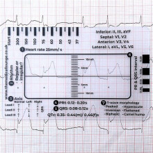 16st EKG 7-Stegslinjal,EKG 7-Stegslinjal för EKG/EKG-Tolkning,EKG-Referensguidelinjal,EKG-Mätmätverktyg
