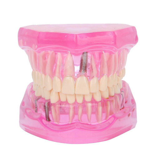 Dental Teaching Model Transparent Adult Teeth Pathological Repair Study Jaw Implants