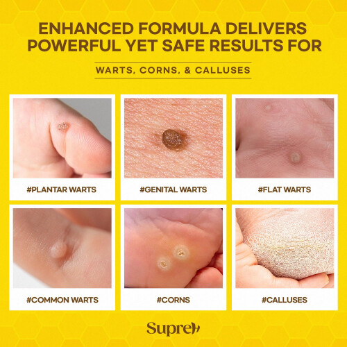 Fast-Acting Bee Venom Wart Remover: Verruca Treatment and Corn 1