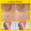 Fast-Acting Bee Venom Wart Remover: Verruca Treatment and Corn 3