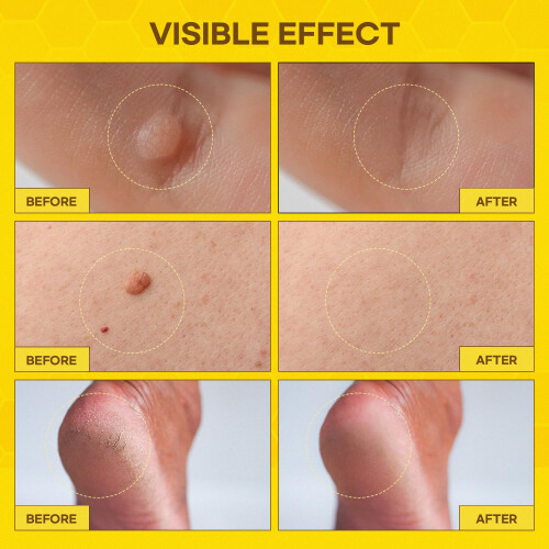 Fast-Acting Bee Venom Wart Remover: Verruca Treatment and Corn 2