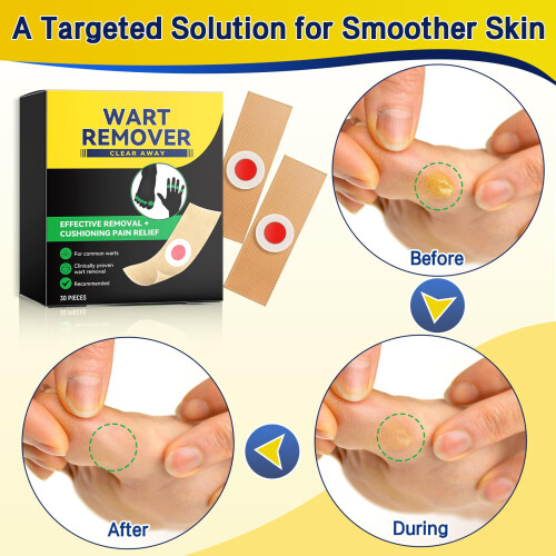 Wart Remover Plasters Patches Maximum Strength Verruca Corn Removal 2