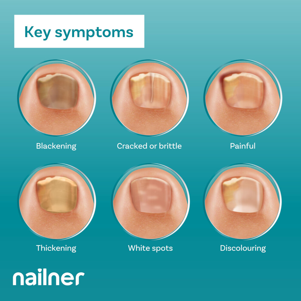 Nailner Fungal Nail Brush 5 Ml - Treat & Prevent Fungal Nail