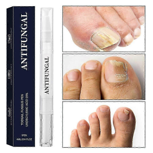 (1pc) Αντιμυκητιασικό Στυλό Undecylenic Acid 25% Φροντίδα Νυχιών Ποδι