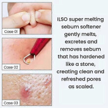 (1pcs) Blackhead Extractor Toner Stronger Blackhead Cleansing Super Melting Sebum Softener ilso Moisturizing Facial Care Koorean