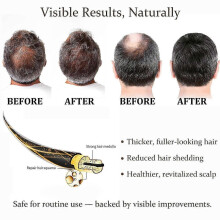 Ginseng Hair Regrowth System: 16x5ml Micro-Infusion Kit with 4 Microneedles for Daily Scalp Nourishment kkoukL