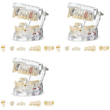 3X Disease Teeth Model Dental Typodonts Implant Teeth Model with Removable Teeth Dentist Standard Tooth Demonstration