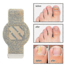 (2Pcs) Nail Fungus Patch Waterproof Nail Repair Patches Nail Ingrown Correction Stickers 1/2/3/4/5pcs For Discolored Or Damaged Nails