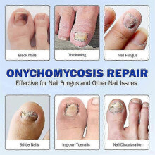 (3Bags) Oenail Fungus Patch Waterproof Nail Repair Patches Nail Ingrown Correction Stickers 1/2/3/4/5pcs For Discolored Or Damaged Nails_usmddsa