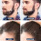 Koi Beauty Derma Roller for Face Hair Beard 0.25mm 4