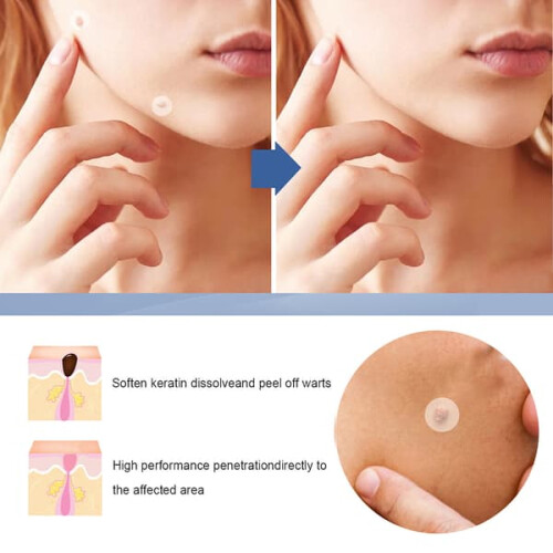 Skin Tag Removal Patches 144 pcs 2