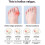 Συμπιεστικό προστατευτικό κάλων Jaws Podiatry – Διορθωτικό μανίκι κάλων & 4