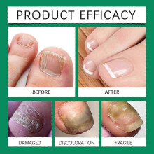 (4PCS) 1-5x Anti-fungal Stick Nailshield Anti Stick,monsalife Anti Stick