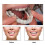 Snap-On Smile Tandenfacings Bleekset2 5