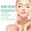 YATLTE hydrocolloid acne patches 102 pcs 8 sizes 3