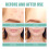 YATLTE hydrocolloid acne patches 102 pcs 8 sizes 6