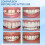 RUOYING Temporary Dental Repair Kit for Teeth 1 Pack 4