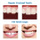 RUOYING Temporary Dental Repair Kit for Teeth 1 Pack 5