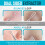 Blackhead Remover Tool Stainless Steel 304 3