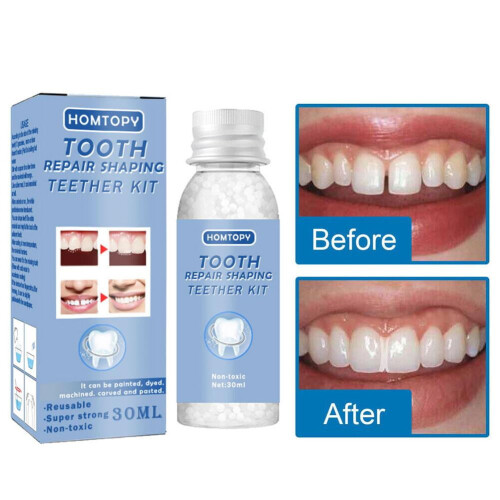 RUOYING Temporary Dental Repair Kit for Teeth 1 Pack 1