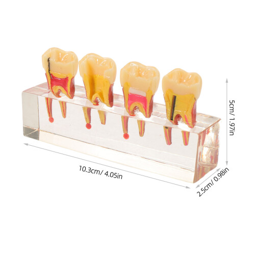 Teeth Model Voor Endodontische Training En Patiëntcommunicatie 1