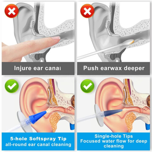 Ear Wax Removal Kit with Multi-Nozzle Design for Safe, Effective Ear Cleaning 1