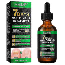 Nail Fungus Treatment, Ginger Nail Fungus Treatment, 7 Days Nail Fungus Treatment for Toenail
