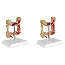 2X Modelo de Cáncer Colorrectal Patológico de Colon Modelo de Intestino Grueso Modelo Anatómico Gastrointestinal