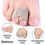 Straightening hammer toes with 6-pack correctors 3