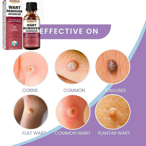 Wart Remover Liquid,Fast Acting to Remove Common and Plantar Warts, Flat Warts 2