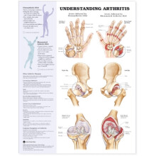 Understanding Arthritis Anatomical Chart Paperback Book