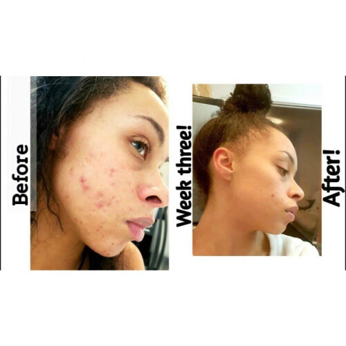 The Ordinary Retinol 1% in Squalane 30ml 1