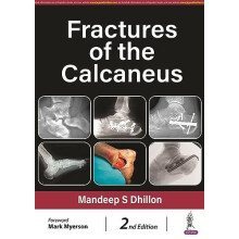 Fractures of the Calcaneus by Mandeep S Dhillon Hardcover Book