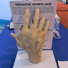 Modello di Mano per Osteoartrite, Modello di Patologia Della Mano, Replica di Anatomia e Fisiologia Umana, Modello Anatomico per Studio Medico