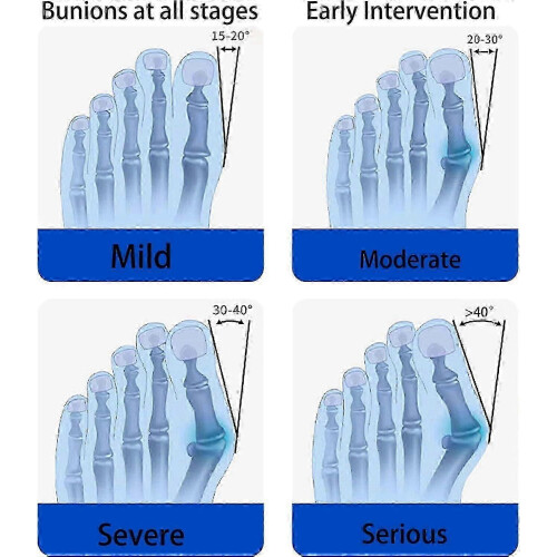 Bunion Corrector Adjustable Knob Design Silicone Pad Pain Relief Toe Splint 1