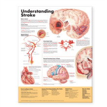 Understanding Stroke Anatomical Chart Paperback Book