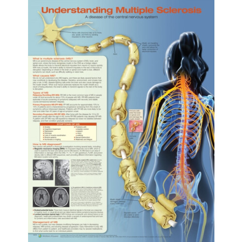 Understanding Multiple Sclerosis Anatomical Chart Paperback Book