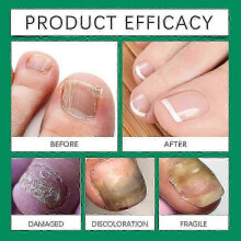 (1) Nail Care Roller Balls - Nourishing Massage For Stronger, Faster-growing Nails With 7-day Nail Growth Formula