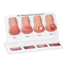 Heel Pressure Injury Stages Model, Heel Ulcer Demonstration Model, Bed Sore Stages Education Tool for Training