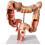 Human Large Intestine Anatomical Model Colon Pathology 1pc 1