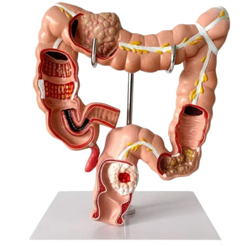 Human Large Intestine Anatomical Model Colon Pathology 1pc