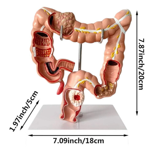 Human Large Intestine Anatomical Model Colon Pathology 1pc 2