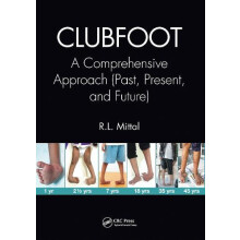 Clubfoot A Comprehensive Approach Past Present and Future by R. L. Mit