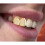 Tooth Caps Elegant Grillz for Single or Double Teeth 4