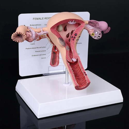 Pathological Uterus and Ovary Model with Base and
