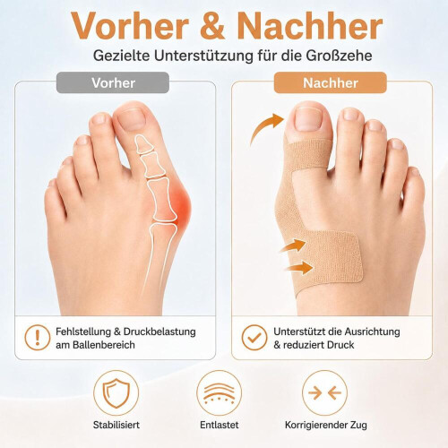 Ταινία διόρθωσης Hallux Valgus, προκομμένες ταινίες κινησιολογίας, φιλική προς 1