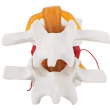 Anatomisch Model van een Lumbale Hernia (1,5 Keer de Ware Grootte) voor Onderwijs en Leren